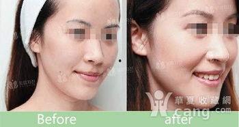 明星注射苹果肌图片,美丽背后的秘密